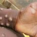 Bénin : le ministère de la Santé alerte sur la variole du singe