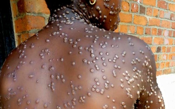 Riposte à la variole de singe: Le Bénin prêt!