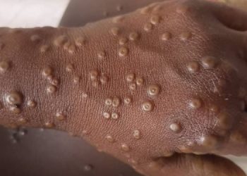 Togo: Un cas de Mpox détecté et confirmé