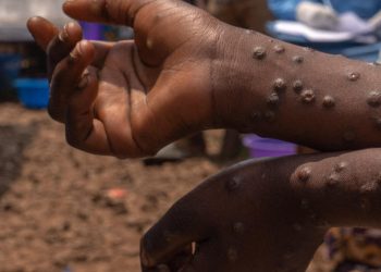 Sénégal : Premier cas confirmé du Mpox