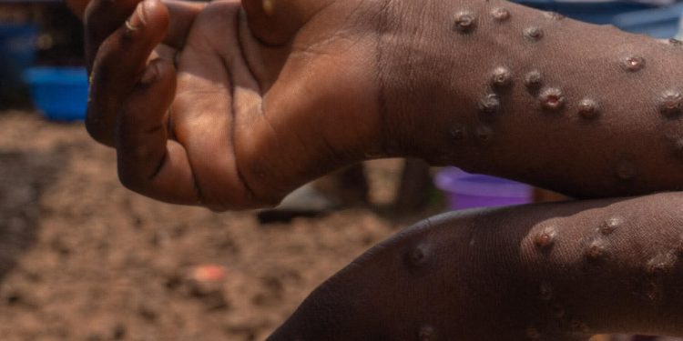 Sénégal : Premier cas confirmé du Mpox