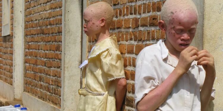 Suite à plusieurs publications concernant « l’Ong Valeur Albinos’’ sur les réseaux sociaux : La présidente apporte des clarifications